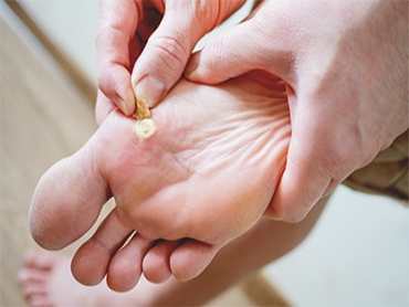 4 Common Foot Skin Problems and Their Treatments