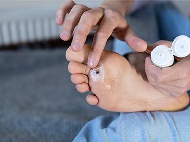 4 Options for Removing Plantar Warts
