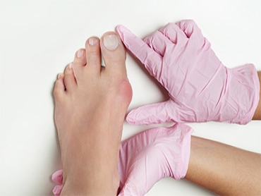 A Simple Guide on Bunions: Definition, Causes, and Prevention