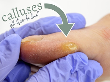 Calluses – What Can You Do?
