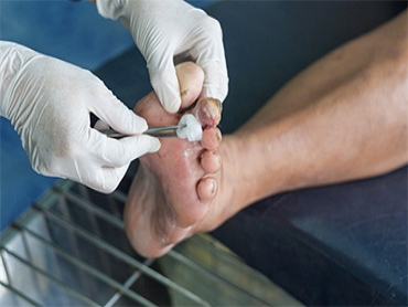 Effective Ways of Treating Foot and Toe Ulcers