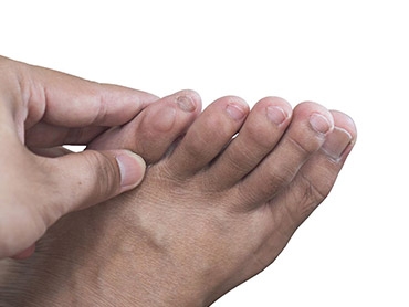 Foot Blisters: Causes, Treatment, and Prevention