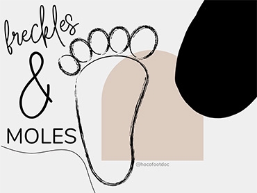 Freckles and Moles