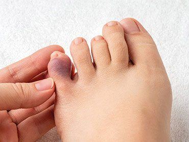 How to Deal with Broken Toes