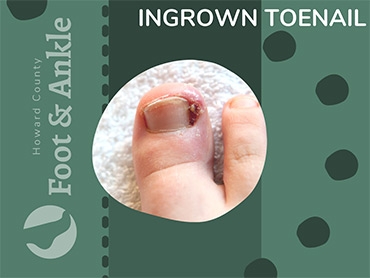 Ingrown Toenails