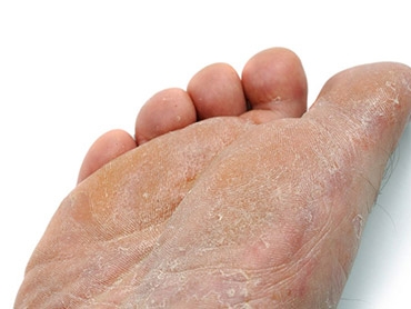 Peeling Feet: What is It and How Do You Prevent It?