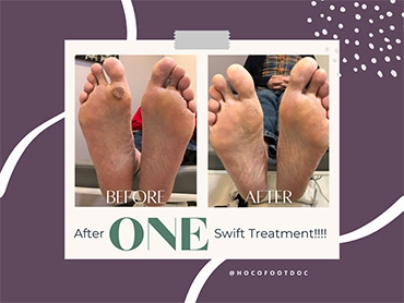 Plantar Warts