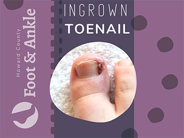 Prevent Ingrown Toenails Before They Happen