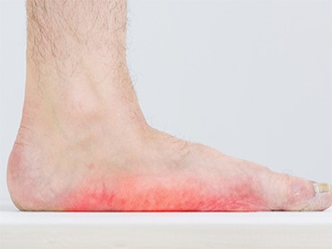 Telltale Signs You Have Flat Feet
