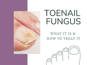 Toenail Fungus