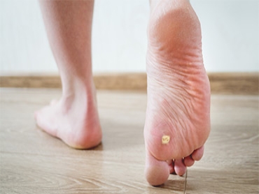 What are Plantar Warts and How Do You Treat Them?