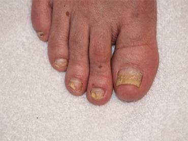 What is Toenail Fungus and How Do You Deal with It?