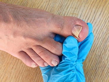 What Should You Do if You Have a Damaged Toenail?