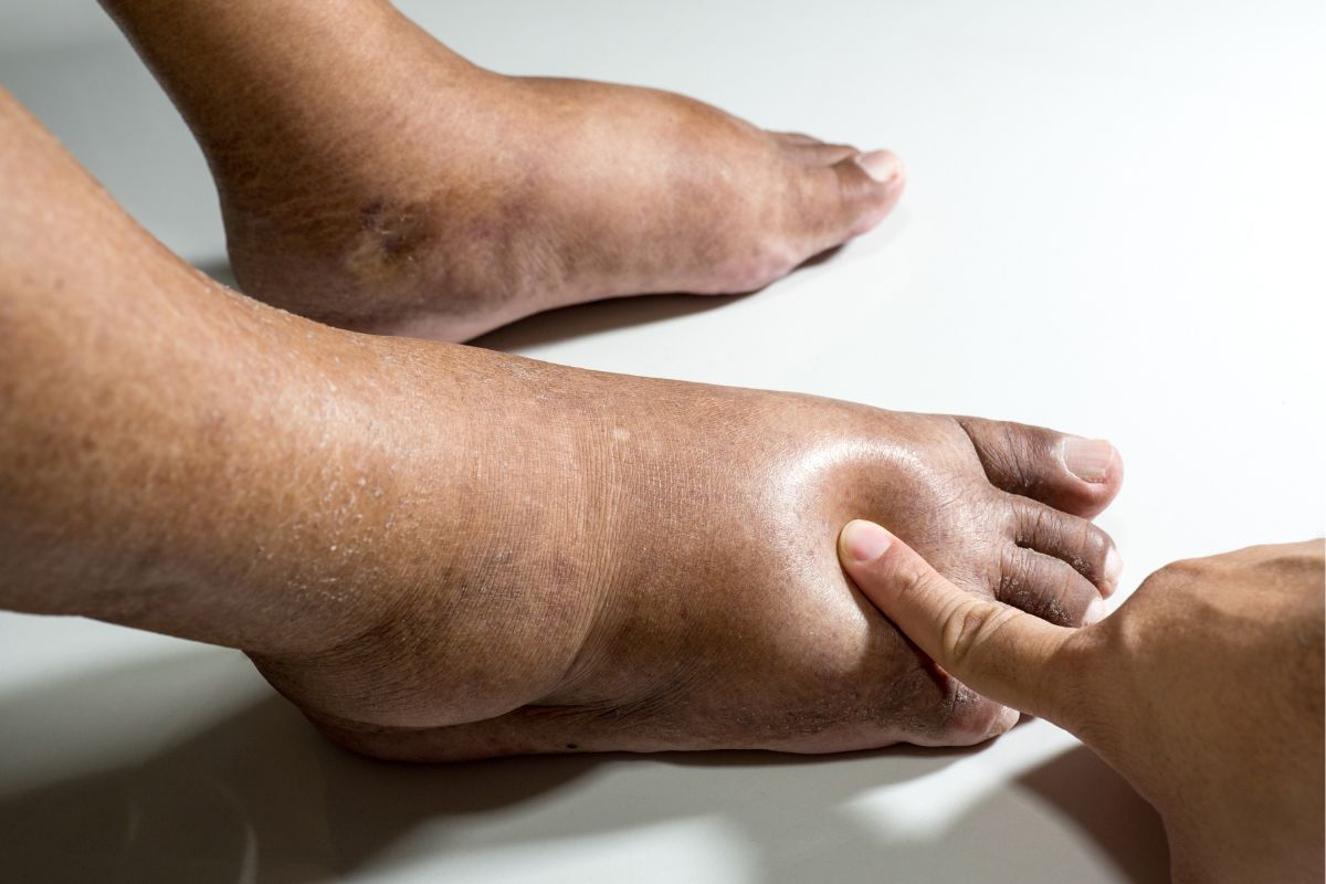 Diabetic feet Pic