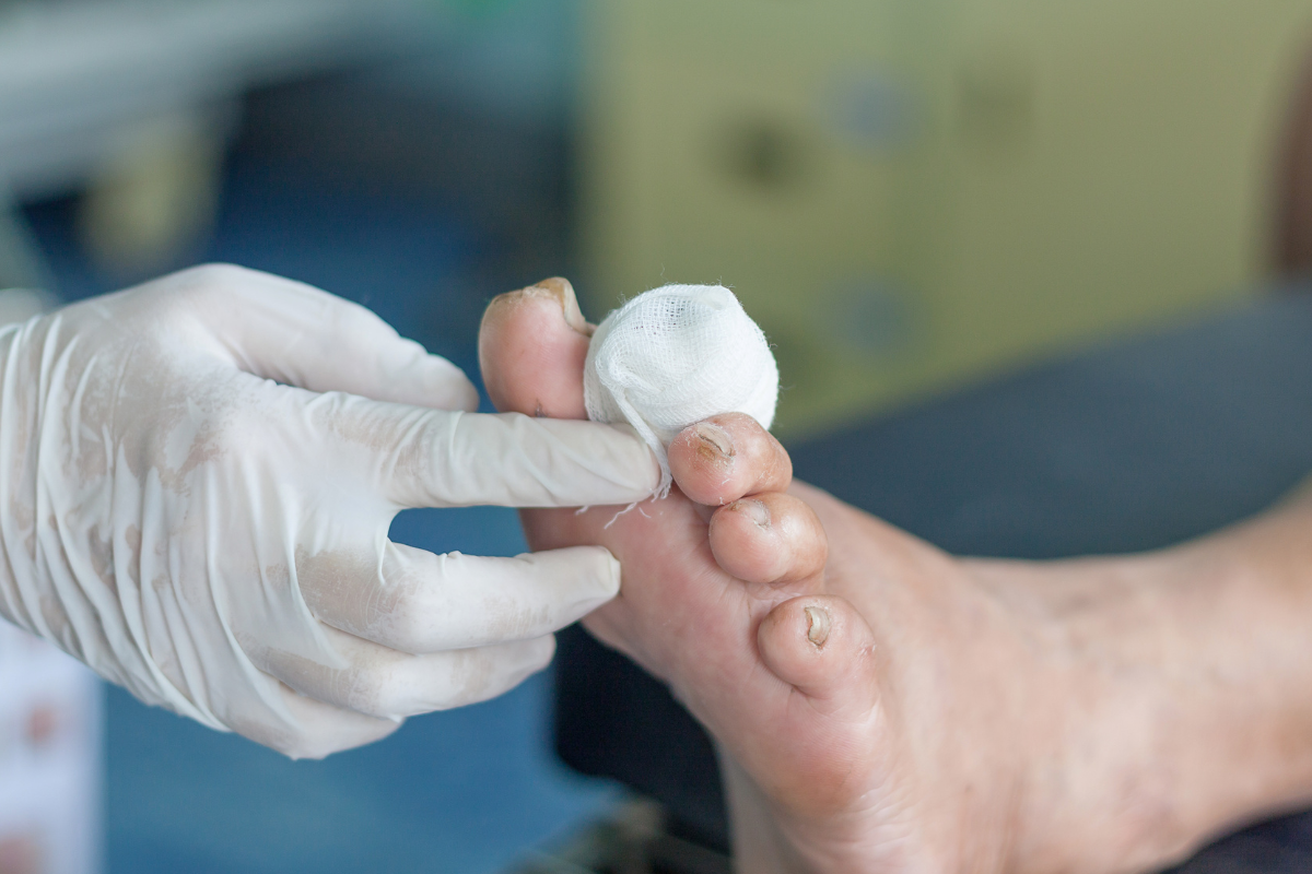 Diabetic Wounds Pic