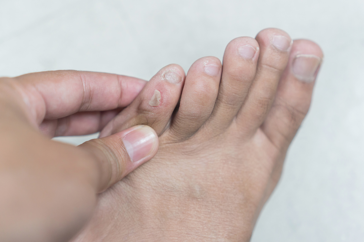 Foot Blisters Pic