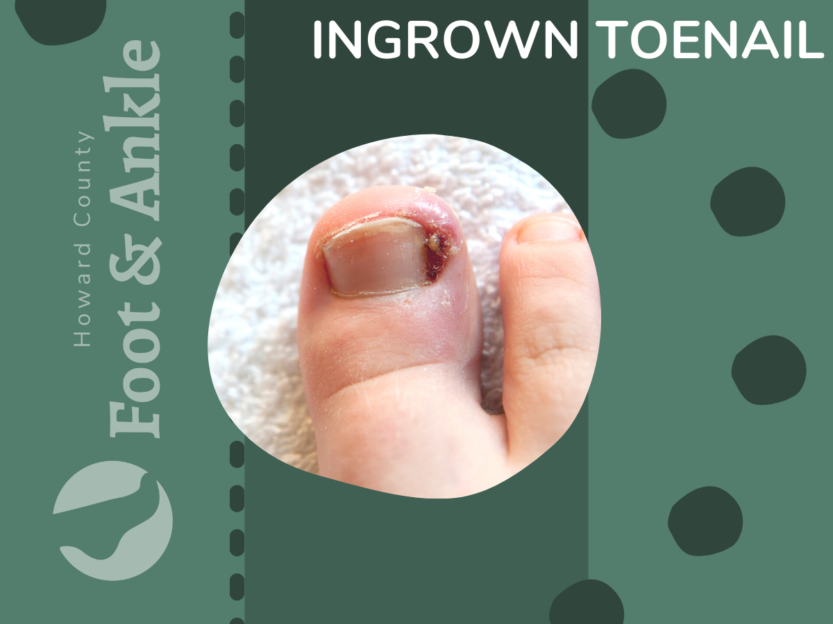 Ingrown Toenails Pic