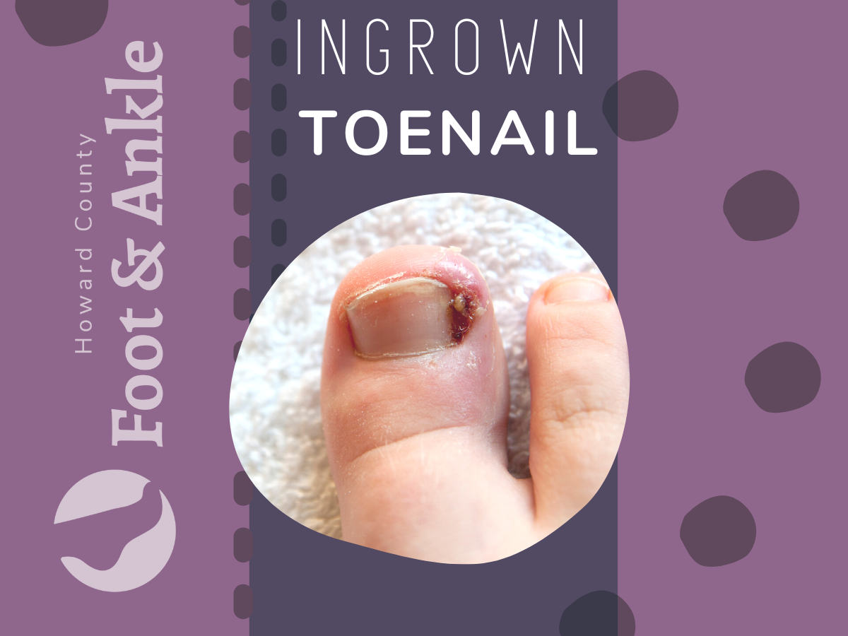 Ingrown Toenail Pic