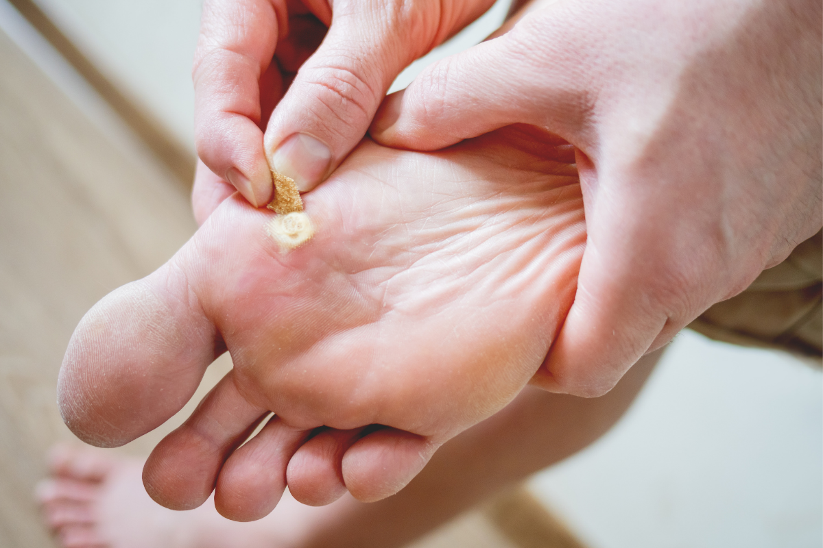 Foot Skin Problems Pic